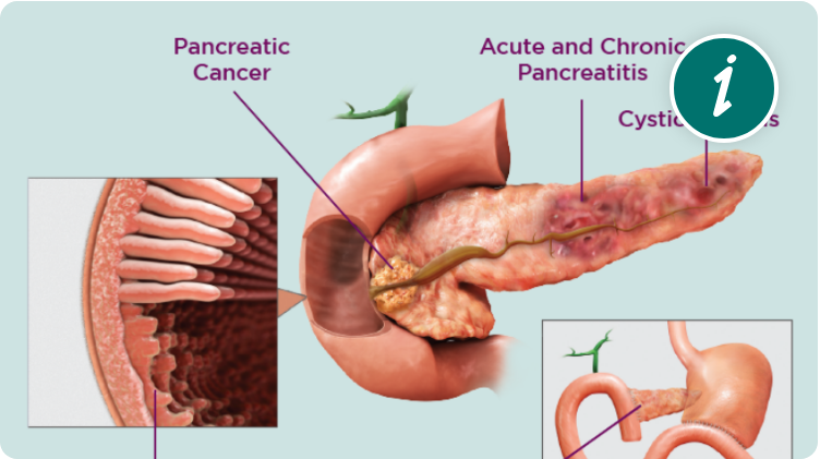 Image showing that EPI Is Caused by Various Pancreatic and Extrapancreatic Conditions such as: pancreatic cancer, acute and chronic pancreatitis, cystic fibrosis, crohn&#39;s disease, celiac disease, pancreatectomy and gastric surgery.